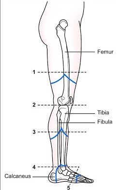 Prosthetic Legs Guide: Types, Costs, & Insurance