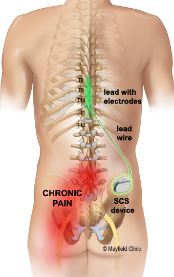 Spinal cord stimulation doesn t help with back pain says new